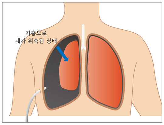 사진=기흉은 옆구리에 관을 꼽아 공기를 제거하고 퇴원하지만 재발률이 높아 근본적인 치료는 흉강경 수술로 기낭을 제거하는 것이다.(강동경희대병원 제공)