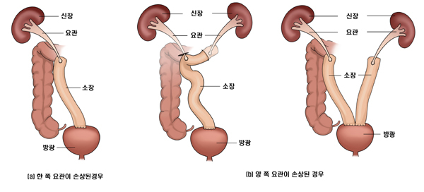 손상된 소변통로(요관) ‘장(腸)’으로 복원해 일상생활 유지