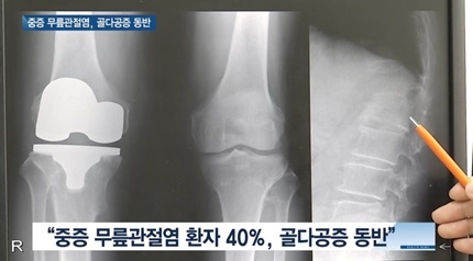 [쿠키건강뉴스] “무릎관절염 심하면 골다공증 위험”… 통증조절·재활 필요