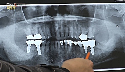 [쿠키건강뉴스-체크리포트] 노년기 입속 세균 활성화…“치아관리 중요”