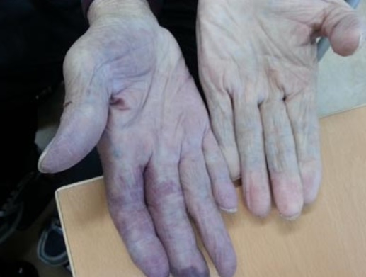 ‘3단계 손발 색깔 변화’…레이노 증후군‧전신경화증‧루푸스 증상