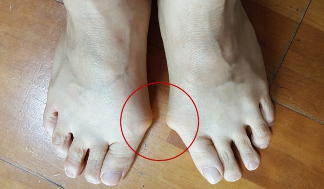 발가락 휘는 ‘무지외반증’, 남성 환자 늘고 있다