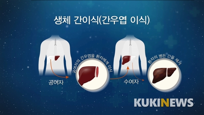 [글로벌 명의 명클리닉] 간이식 수술로 난치성 간암 환자 1000명 이상 구해