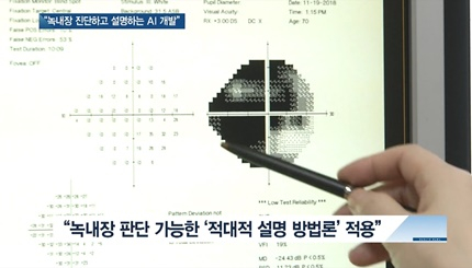 [쿠키건강뉴스] “녹내장 진단부터 설명까지”…현장활용 높인 AI 개발