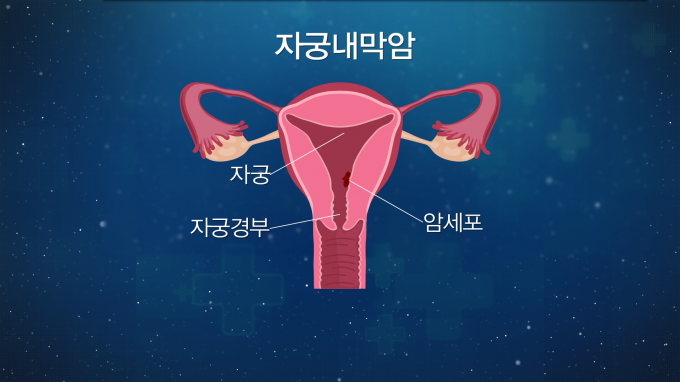 [글로벌 명의 명클리닉] 난소암 등 부인암 전문가 이근호 서울성모병원 산부인과 교수