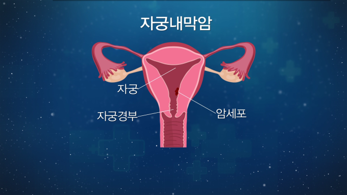 [글로벌 명의 명클리닉] 난소암 등 부인암 전문가 이근호 서울성모병원 산부인과 교수