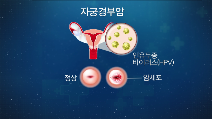 [글로벌 명의 명클리닉] 난소암 등 부인암 전문가 이근호 서울성모병원 산부인과 교수