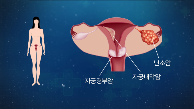 [글로벌 명의 명클리닉] 난소암 등 부인암 전문가 이근호 서울성모병원 산부인과 교수