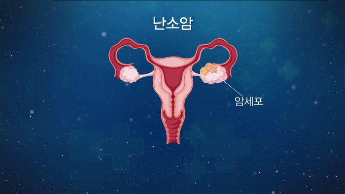 [글로벌 명의 명클리닉] 난소암 등 부인암 전문가 이근호 서울성모병원 산부인과 교수