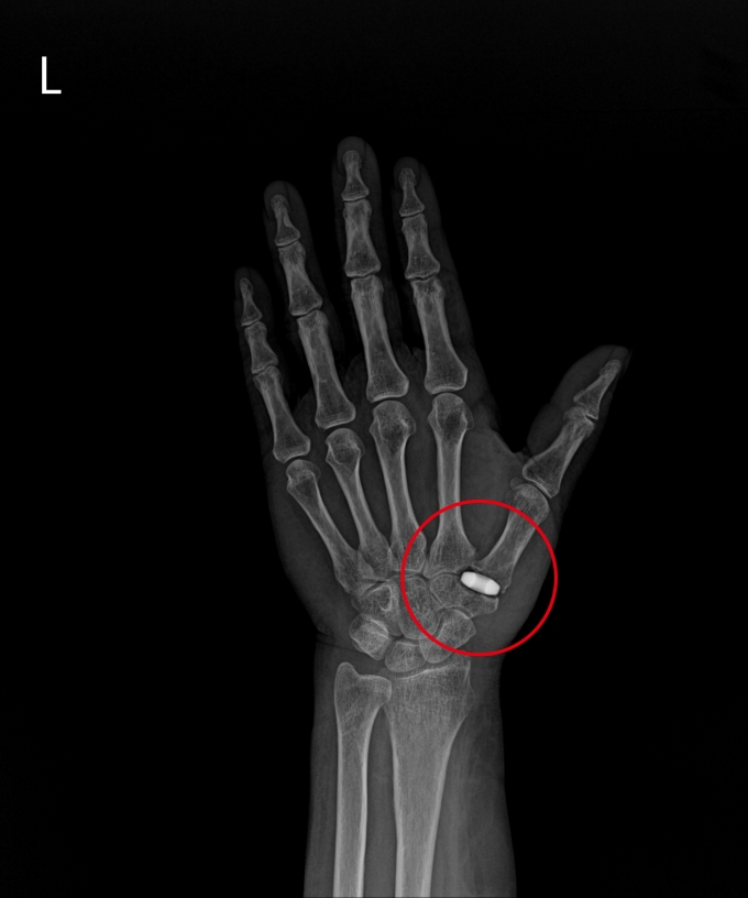 [정동리포트] 손가락에도 인공관절 수술을?…기능 회복 효과 기대