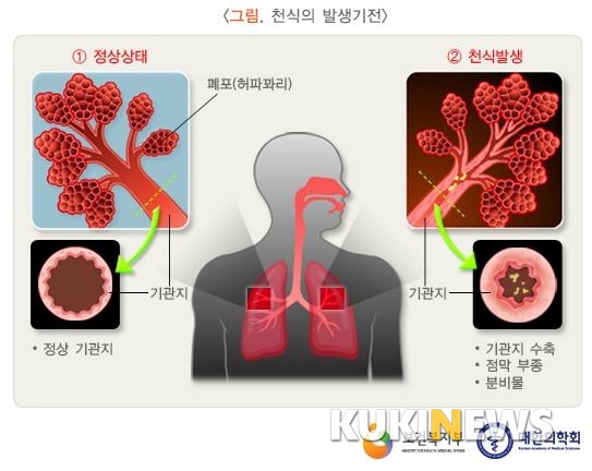 [한방의숨결] 소아천식, 90% 이상 초등학교 때 시작