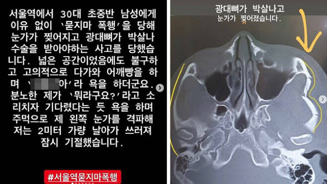 ‘서울역 묻지마 폭행’ 피해자 “겉보기엔 멀쩡한男…한 대 더 치려해”
