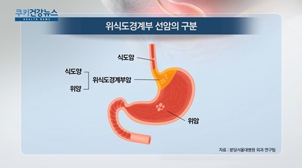 [쿠키건강뉴스] 위·식도 경계암 특성 규명…“치료법 진전 기대”