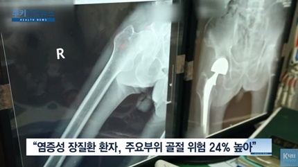 [쿠키건강뉴스] “염증성장질환 환자, 척추·고관절 골절 위험 더 높아”