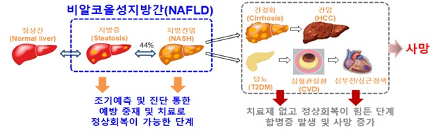 '비알코올성 지방간' 심하면 10년 내 심혈관계질환 위험 4~5배 ↑