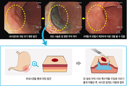 조기 위암 내시경 치료, 치료비용 낮추고 치료효과↑