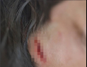 [옐로카드] 네덜란드 ‘상패’ 피해자 “끝까지 책임진다더니…1년만 치료비 지급한다네요”