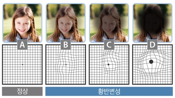 3대 실명 질환 '황반변성' 예방엔 노른자·시금치·커피가 도움