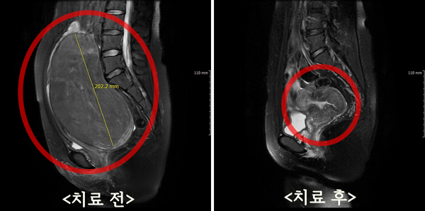 [쿠키리포트] 자궁근종 제거 하이푸 시술, ‘자궁보존’이 최대장점  