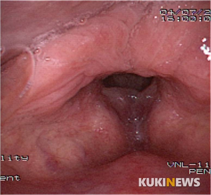 [하나ENT리포트] 겨울철 찬 공기, 쉰 목소리 성대부종 부른다