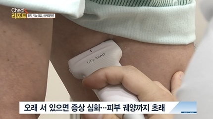 [쿠키건강뉴스-체크리포트] 돌아오지 않는 혈액, 하지정맥류…“꾸불꾸불한 핏줄·피곤한 다리, 상태 심하면 망가진 혈관 제거술로 치료”