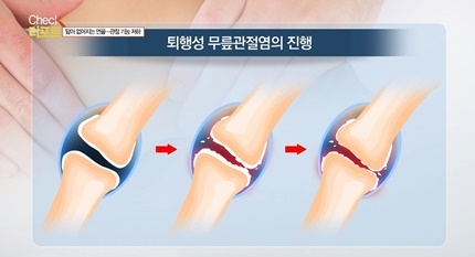 [쿠키건강뉴스-체크리포트] 퇴행성 무릎관절염, 연골 닳아 관절변형·기능장애 우려…“인공관절 사용 수명 15년, 구조물 마모 시 재수술”