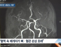 [쿠키건강뉴스] “뼈 약해지면 뇌혈관 위험”…뇌졸중 환자 61%, 골밀도 저하