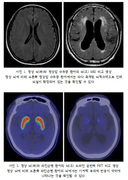 노인 100명 중 2명은 '정상압 수두증'…'파킨슨병' 동반되기도