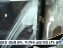 [쿠키건강뉴스] “염증성장질환 환자, 척추·고관절 골절 위험 더 높아”