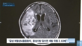 [쿠키건강뉴스] “중성지방 수치 높으면 급성 뇌졸중 재발 위험 커져”