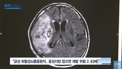 [쿠키건강뉴스] “중성지방 수치 높으면 급성 뇌졸중 재발 위험 커져”