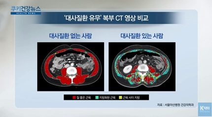 [쿠키건강뉴스] “지방 적은 질 좋은 근육 많으면 대사질환 위험 낮아”