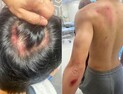 흉기 난동범 오인해 중학생 진압…“아들 전신 찰과상에 멍”