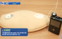 첨단기기가 만드는 새로운 장기, ‘인공췌장’ [이노메디④]